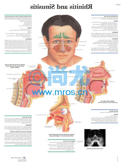 ¹Ȧ Rhinitis and Sinusitis Ŵ